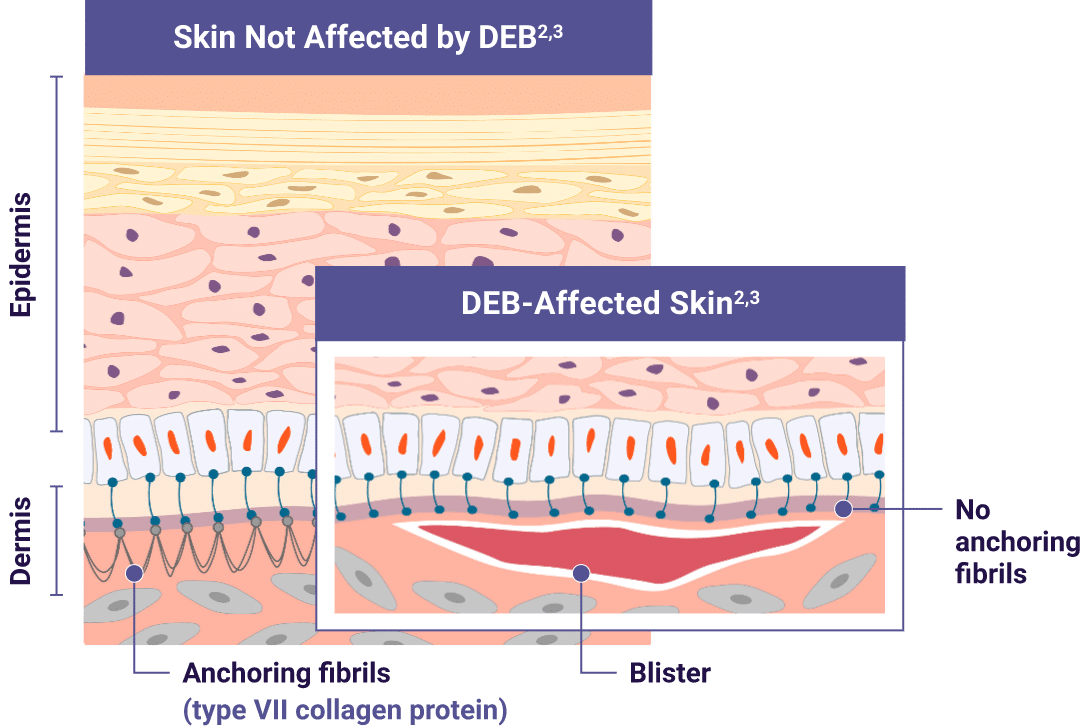 Comparison of skin not affected and affected by DEB