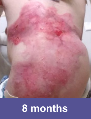 Back wound after 8 months of VYJUVEK™ treatment