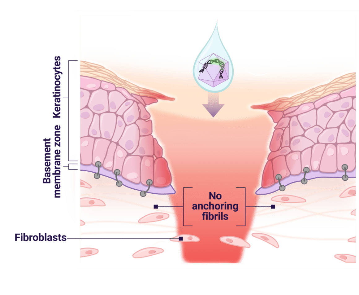 Fibroblasts and lack of anchoring fibrils
