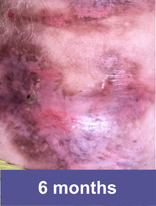 Lower abdomen wound after VYJUVEK™ treatment