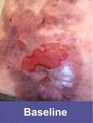Lower abdomen wound before VYJUVEK™ treatment