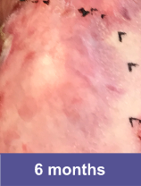 Lower shoulder blade wound after VYJUVEK™ treatment