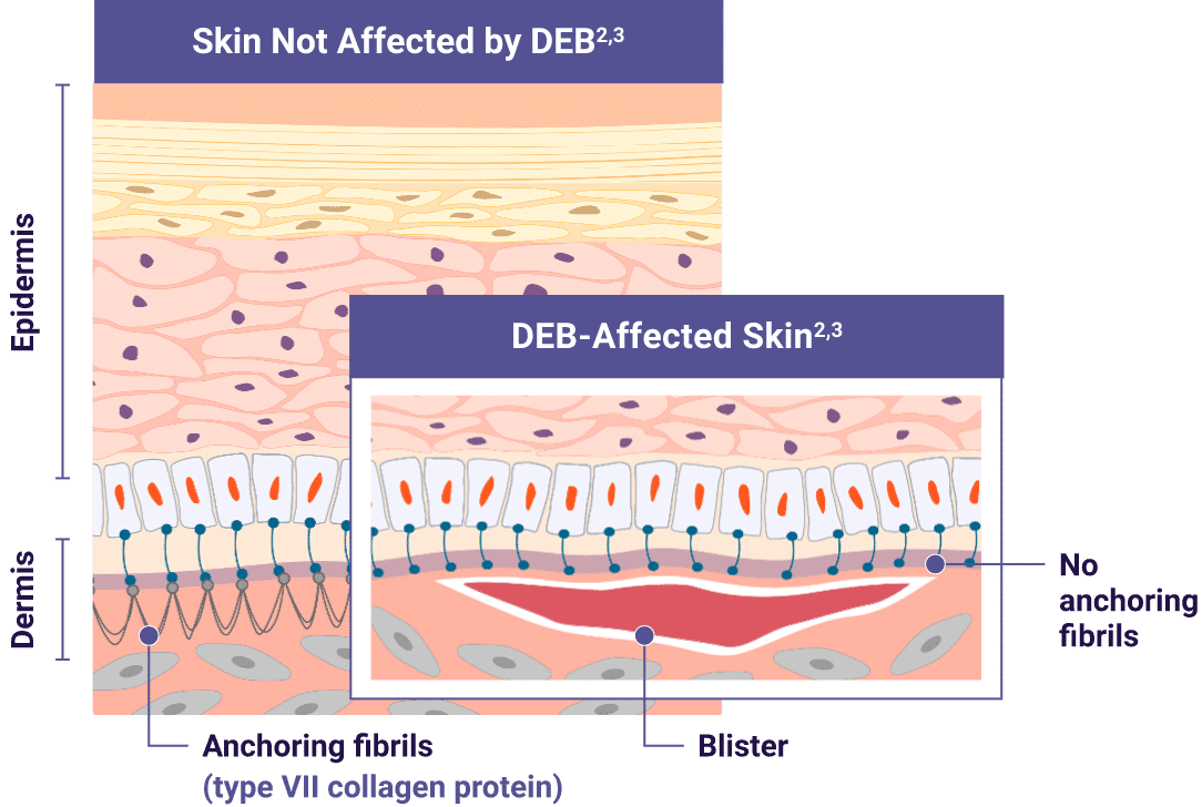 MOD–DEB affects the dermis by causing insufficient formation of anchoring fibrils